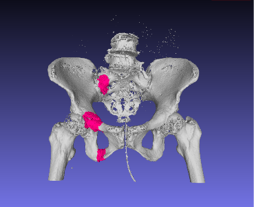 骨盤CT画像から骨折を自動検出